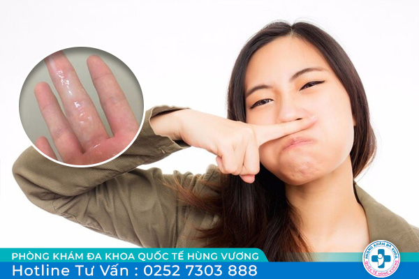 Huyết trắng có mùi hôi là do đâu? Điều trị ra sao?