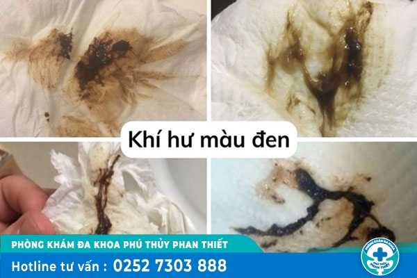 Ra dịch màu đen là dấu hiệu bệnh gì? Có nguy hiểm không?