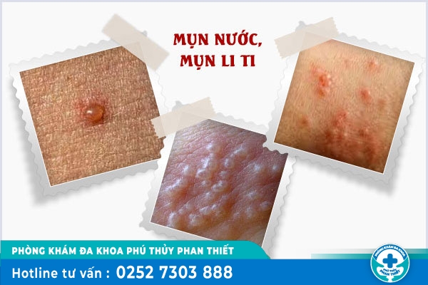 Cách chữa trị nổi mụn li ti vùng kín hiệu quả nhanh, ít tốn kém