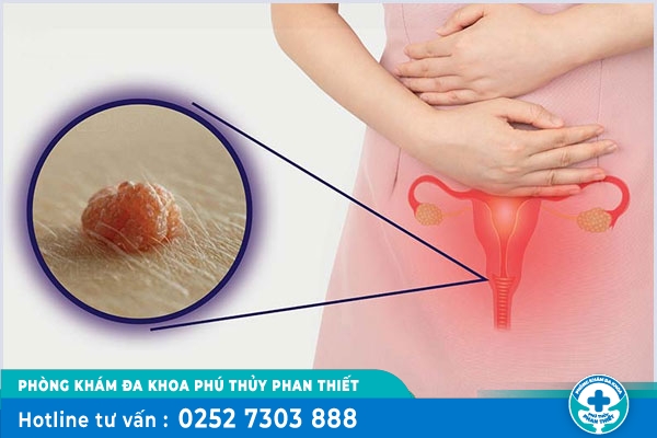 Nổi mụn ở hột le là bị gì?