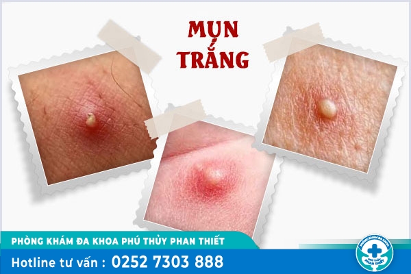 Nổi mụn trắng vùng kín là bệnh gì?