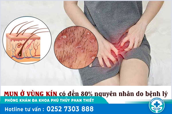 Mụn lông mu: Nguyên nhân và nơi điều trị hiệu quả