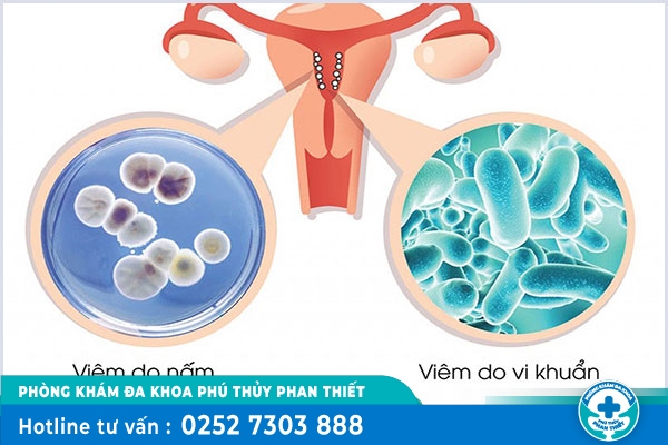 Bị viêm phụ khoa nữ: Nguyên nhân, dấu hiệu nhận biết và cách điều trị